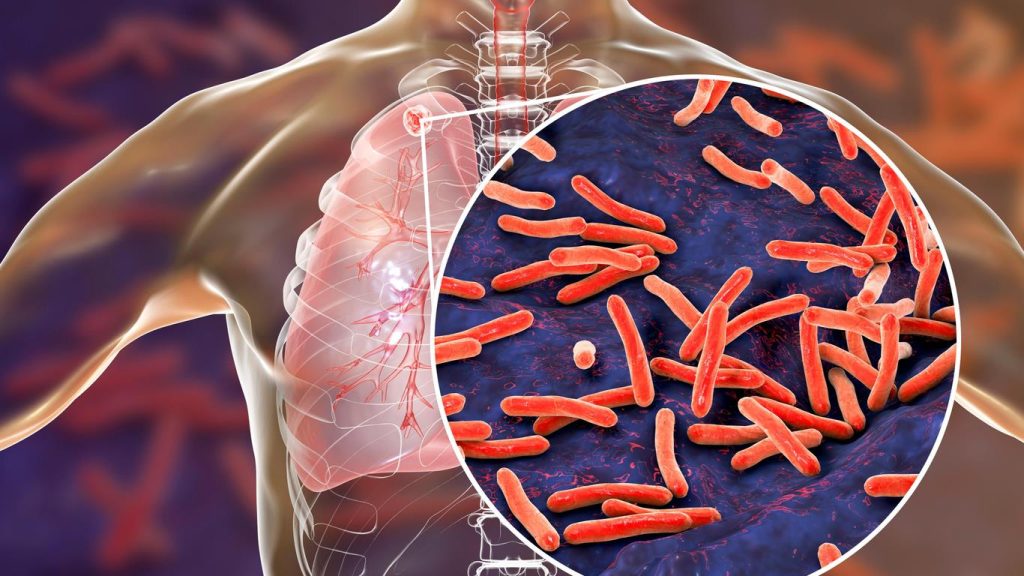 tuberculose