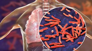 tuberculose